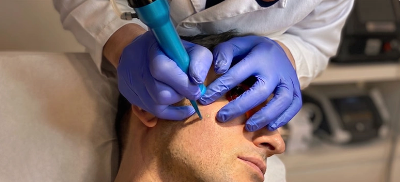 Láser vascular