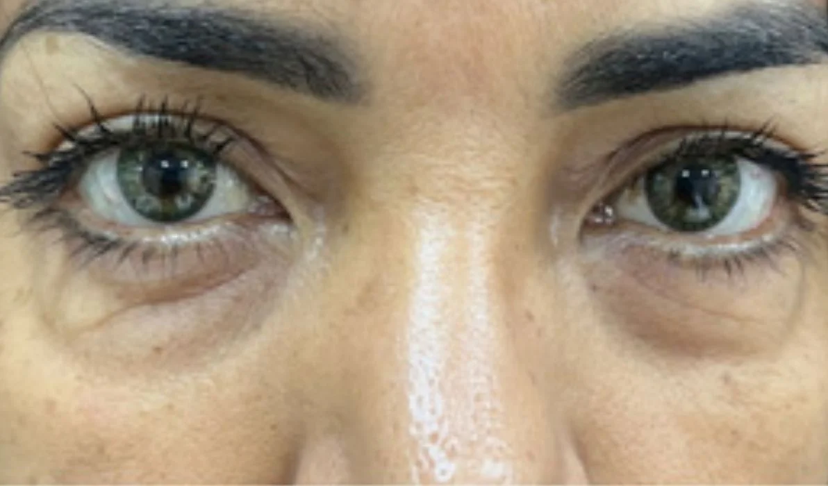Antes  de la eliminación de ojeras - paciente 3