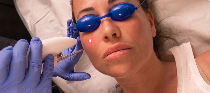 Láser dermatológico avanzado