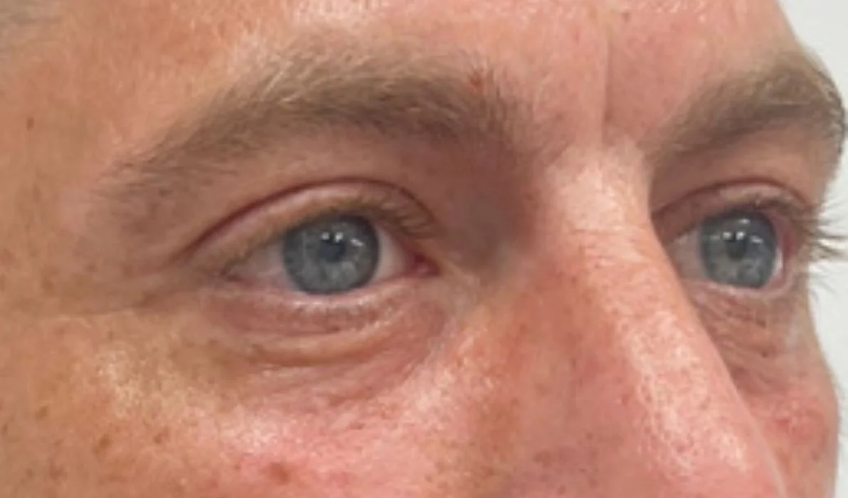 Después de la eliminación de ojeras - paciente 1