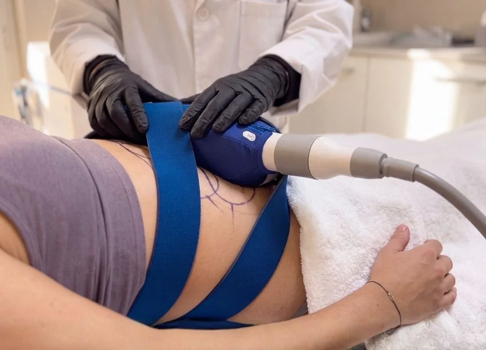 En qué consiste el Coolsculpting Elite