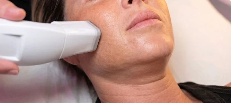 Radiofrecuencia facial 